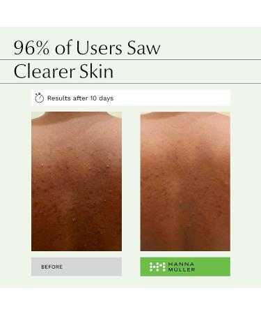 Tea Tree Body Wash - 5% Australian Tea Tree Oil & Aloe Vera - Acne Fighting & Hydrating Formula - Buy Online on GoSupps.com