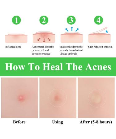 BREYLEE Acne Pimple Patch (66 Count) - Tea Tree Oil & Hydrocolloid Zit Healing Patch - 10mm+12mm - Pack of 3 - Buy Online on GoSupps.com