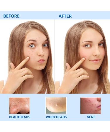 Blackhead Remover Tool Kit - 5 Pack Professional Stainless Steel Extractor Tools for Face and Nose - Pimple Popper, Comedone, Acne, and Whitehead Removal with Case - Buy Online on GoSupps.com