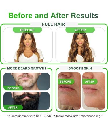 KOI BEAUTY Adjustable Derma Stamp- 140 REAL NEEDLE Professional Microneedling 0-3mm Home Dermastamp for Face Hair Scalp Beard Growth Body Derma Roller & Microneedling Pen Alternative for Men Women - Buy Online on GoSupps.com