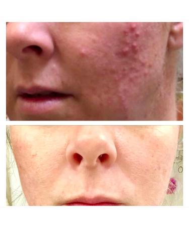 Mandelic Acid Peel 40% for Face - Professional Intense Chemical Peel for Rosacea, Acne, Hyperpigmentation & Melasma - Alpha Hydroxy Acid Skin Brightening Treatment - 1 Fl Oz - Buy Online on GoSupps.com