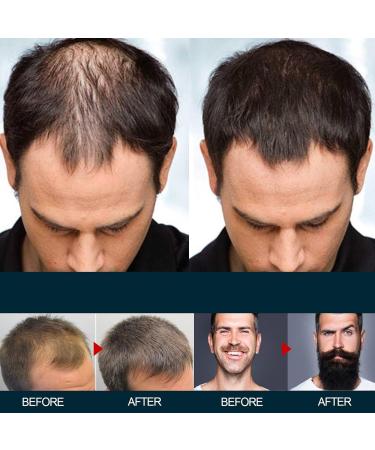  Generisch 5% Minoxidil Foam for Men and Women Minoxidil 5% Hair Growth Serum for Hair Growth Hair Loss Treatment Beard Growth for Lo - Buy Online on GoSupps.com