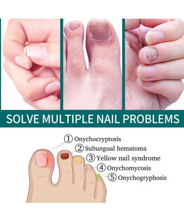 2 IN 1 Nail Fungus Treatment Oil - Fast Relief for Toenail Paronychia & Fungal Infections - Buy Online on GoSupps.com