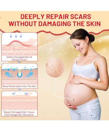 Stretch Mark Oil for Pregnancy | Natural Skincare Massage Oil for Scars & Stretch Marks | Pre & Postpartum Care 4.2 fl. oz - Buy Online on GoSupps.com