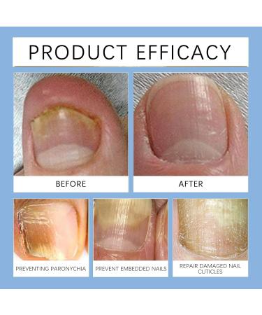 VKaoess Nail care serum with cuticle oil and nail strengthener Nail repair for growth and damaged nails Extra strong nail hardener with strengthening nail polish for toenails 5 Bottles - Buy Online on GoSupps.com