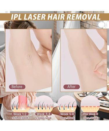 At-Home IPL Hair Removal Device | Permanent Laser Hair Removal 999900 Flashes | For Facial, Legs, Arms & Body Treatment - Buy Online on GoSupps.com