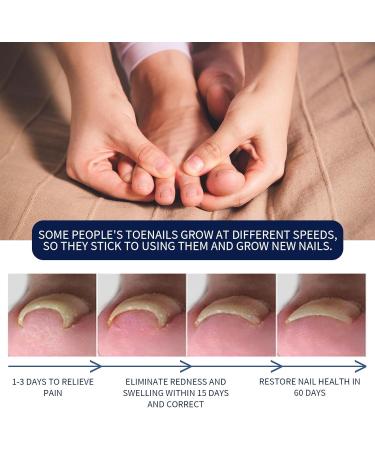 Ingrown Toenail Treatment and Removal Relief Oil - Nail Growth and Fungal Corrector - Buy Online on GoSupps.com
