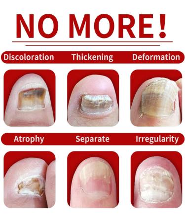 Fungal Nail Treatment Nail Fungus Treatment for Toenail Ingrown Toenail Treatment Toe Nail Fungal Treatment Fungal Nail Treatment for Toenails Extra Strong Nail Repair Treatment Repairing Broken Nail - Buy Online on GoSupps.com