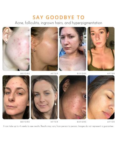 Face & Body Clearing Serum Level 1- for acne folliculitis aging skin ingrown hairs dark spots - face chest butt back thighs arms - mandelic acid - 1 fl oz - Buy Online on GoSupps.com