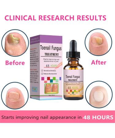 Fungal Nail Treatment - Toe Nail Fungal Treatment - Nail Fungus Treatment for Toenail and Fingernails - Anti fungus Nail Repair and Strengthen Fix & Renew Damaged Broken Nails - Buy Online on GoSupps.com