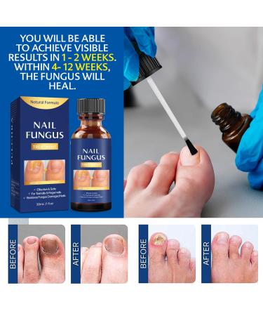 Extra Strength Toe Nail Fungus Treatment - Effective Nail Repair Solution for Healthy Nails - Buy Online on GoSupps.com