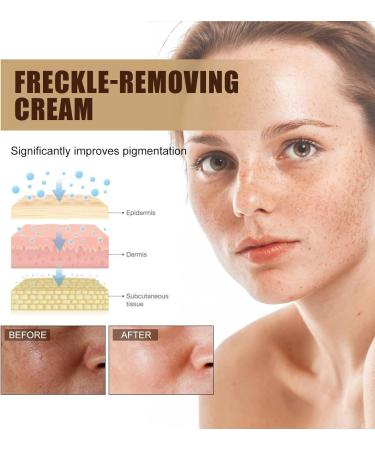 KOAHDE Freckle Removal Cream For Face Freckle Cream Anti Melasma Facial Moisturize Cream Moisturizing Anti-Blemish Cream Pigmentation Removal Cream for Face Skin Brightening Cream Dark Spot Corrector - Buy Online on GoSupps.com