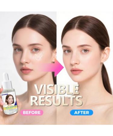 Sylvirene Milia Remover Treatment Serum 40ml Milia Removal for Eyes & Face Milia Acne Serum Fat Granule Clearing Skin Essence - Buy Online on GoSupps.com