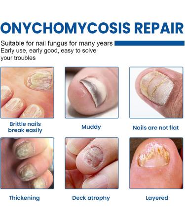 Fungal Nail Treatment Nail Repair Patches Nail Fungus Treatment for Toenail Fungal Nail Patches Extra Strong Nail Repair Treatment for Restores Damaged Nails - 32 Patches - Buy Online on GoSupps.com
