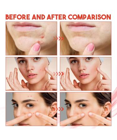 Hydrocolloid Pimple Patches for Day & Night | Invisible Acne Treatment | Breathable Skin Care Solution - Buy Online on GoSupps.com