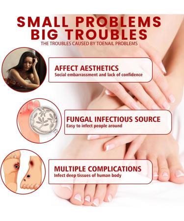 TBeautfave Fungal Nail Treatment Antifungal Nail Treatment Toe Nail Fungal Treatment Fungal Nail Treatment for Toenails Extra Strong Nail Repair and Strengthen Fix & Renew Damaged Broken Nails - Buy Online on GoSupps.com