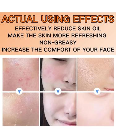 Salicylic Acid Face Moisturizer for Women - Face Cream for Women - Acne Repair Face Cream - Spot Cream for Acne & Pimple - Moisturizer Face with Salicylic Acid - Buy Online on GoSupps.com