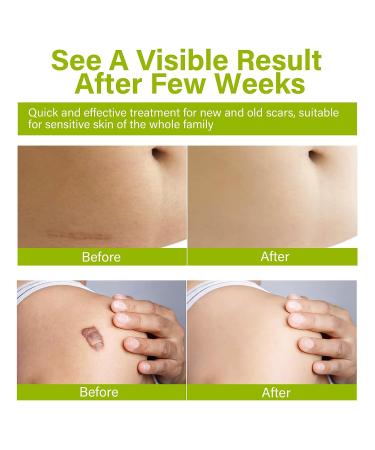 iTecFreely Keloid Scar Treatment for Nose & Belly Piercings - Silicone Scar Gel for Stretch Marks, Burns & Surgery Scars - Buy Online on GoSupps.com