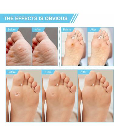 Wart Remover Plasters for Hands & Feet - Corn & Verruca Removal - Plantar Warts & Callus Treatment - 24pcs - Buy Online on GoSupps.com