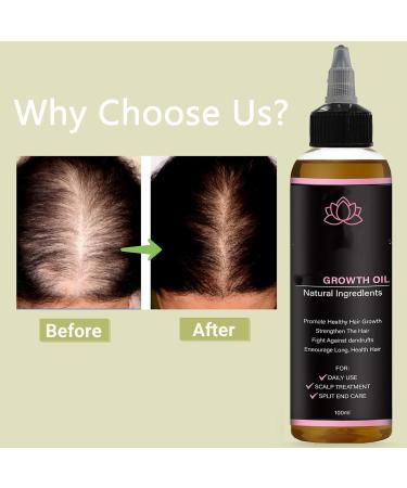 Huile de croissance des cheveux Lifewitqueenp Queenp Ayurvedic Hair Growth Huile l ger pour tous les types de cheveux 1Pcs - Buy Online on GoSupps.com