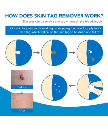 2-IN-1 Skin Tag Tool Kit for Men and Women Fast and Easy Painless Kit for Small (2mm) to Medium (8mm) - Safe for Most Parts - Blue (Blue) - Buy Online on GoSupps.com