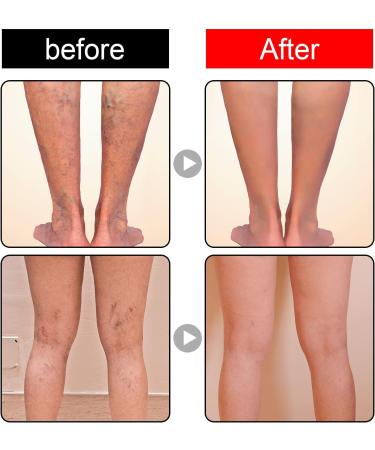  Katutude Veinopro Varicose Veins Treatment Soaps for Legs and All Skin Types (2 Pack) - Buy Online on GoSupps.com