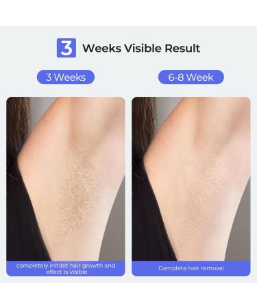 Painless Sapphire Ice IPL Hair Removal Device - Safe at Home & Unlimited Flashes for Men & Women - Buy Online on GoSupps.com