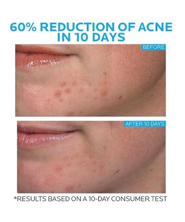 La Roche-Posay Effaclar Duo Dual Action Acne Spot Treatment Cream with Benzoyl Peroxide Acne Treatment Blemish Cream for Acne and Blackheads Safe For Sensitive Skin 1.35 Fl Oz (Pack of 1) - Buy Online on GoSupps.com