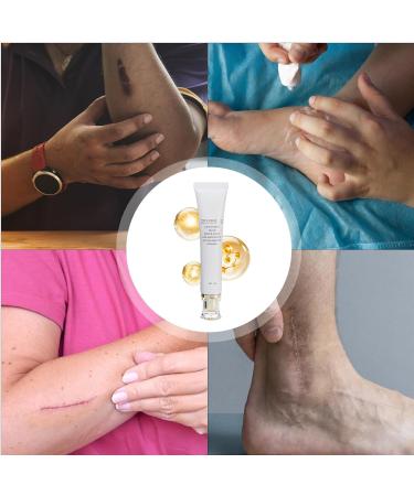 Anti-Scars Product | 30g Natural Moisturizer Skin Care Products - Body Scar Cream | For Morning Day Night Face Body Travel Home Piercing Scar Brands - Buy Online on GoSupps.com