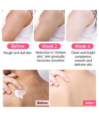 Strawberry Legs Treatment for Women | Bump Eraser Body Scrub & Keratosis Pilaris Cream | Smoothing Buffing Body Care - Buy Online on GoSupps.com