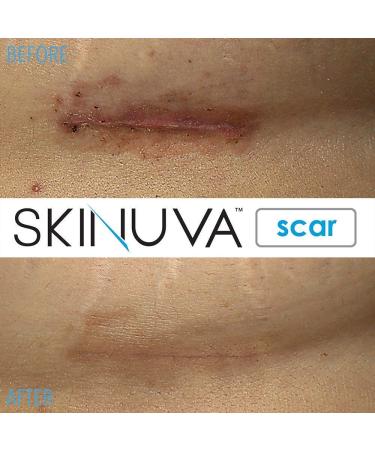 Skinuva Scar Cream & Brite Hyperpigmentation Treatment Set - 1oz | Advanced Scar Removal & Skin Brightening | Growth Factor Formula - Buy Online on GoSupps.com