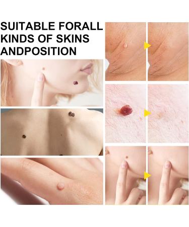 Skin Tag Tool Kit for Men and Women Micro Skin Tags Skin Tag Tool Kit for Small (2mm) to Medium (8.5mm) Skin Tags Fast and Easy to Operate Safe for Most - Buy Online on GoSupps.com