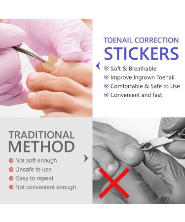 Ingrown Toenail Correction Patch - 100PCS Ingrown Toenail Sticker Breathable Toenail Corrector Patch Professional Ingrown Toenail Tool Painless Pedicure for Ingrown Toenail - Buy Online on GoSupps.com
