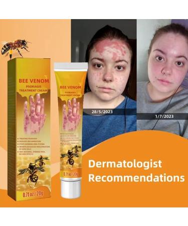 Professional Psoriasis Treatment Cream with New Zealand Bee Venom - Soothing & Moisturizing Formula - 5PCS - Buy Online on GoSupps.com