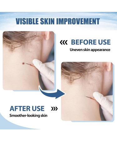 NateNatenight Molluscum Support Treatment Molluscum Support Cream All Natural Support Cream for Molluscum Rash 30g - Buy Online on GoSupps.com