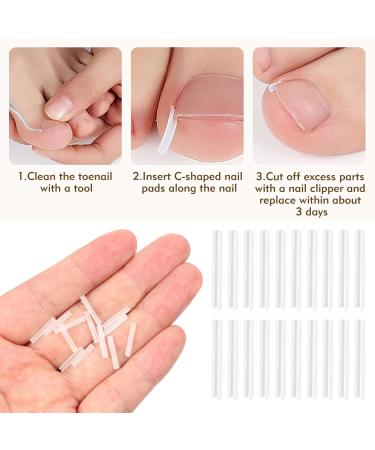 102Pcs Ingrown Toenail Kit Ingrown Toenail Corrector for Ingrown Toenail Treatment Including 80 PCS Ingrown Toenail Corrector 20 PCS C Shape Filling Pad and 2 Styles Ingrown Toenail Tools - Buy Online on GoSupps.com