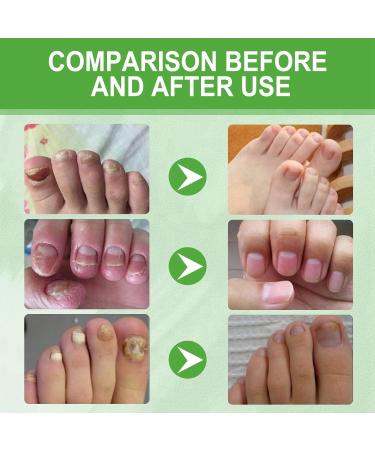 Keratin 3 Day Growth Nail Treatment & Strengthener Nail Growth and Strengthener Fast Keratin Nail Hardener Nail Hardener Oil Nail Polish Strengthener for Thin Nails Nail Strengthener for Damaged Nails - Buy Online on GoSupps.com