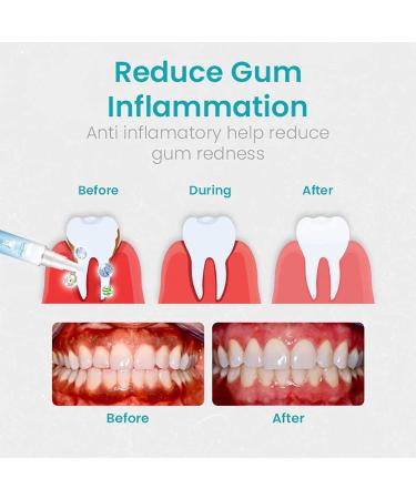 Neslemy Gum Shield Therapy Gel Dentizen Gum Therapy Gel Gum Repair Treatment Gel Teeth Whitening Gum Shield Neslemy Gum Gel Teeth Whitening Gel (2pcs) - Buy Online on GoSupps.com