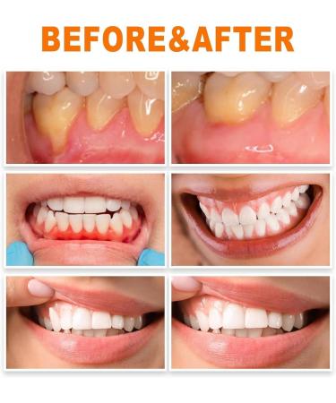 Gum Repair Treatment Ampoules Oral & Gum Care Essence for Tartar Removal Tooth Repair & Gum Protection. (2box) - Buy Online on GoSupps.com
