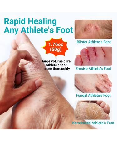 LMNOOP Athletes Foot Treatment Cream Maximum Strength - Antifungal Foot Cream for Itching, Blister, Burning, and Cracking - Natural Herbs - 1.76oz - Buy Online on GoSupps.com