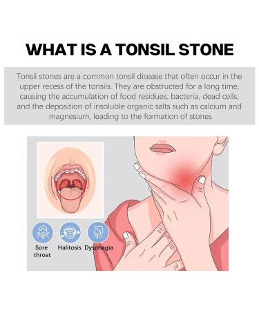 Tonsil Stone Remover Vacuum Kit - Gentle & Effective Oral Care Mouth Cleaner for Adults (2 Random Colors) - Buy Online on GoSupps.com