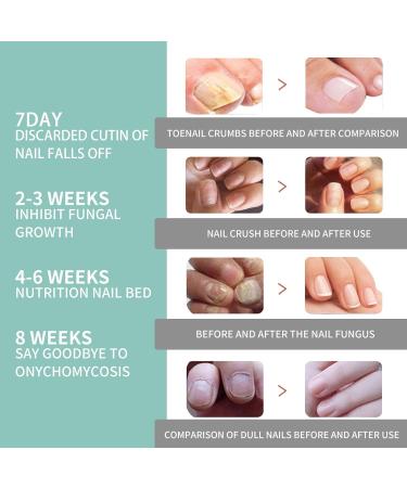 Nail Care Pen Set - 6 Pieces for Nail Fungus Treatment | Fast Growth & Healthy Nails with Aloe Vera Tea Tree Oil & Vitamin E - Buy Online on GoSupps.com