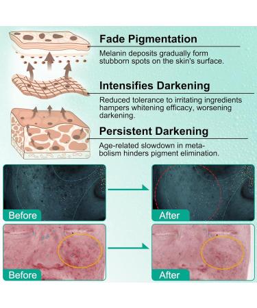 Anti-Dark Spot Face Serum Anti-Dark Spot Face Cream with Retinol and Hyaluronic Acid Anti-Aging Freckle Pigment and Melasma Serum for Face and Body - 50ml - Buy Online on GoSupps.com
