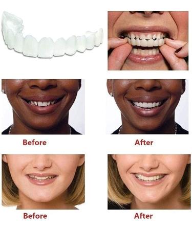 Giural Veneer Snaps Teeth - 2 Pairs of Instant False Teeth for Men & Women | Immediate Prostheses for a Perfect Smile - Buy Online on GoSupps.com