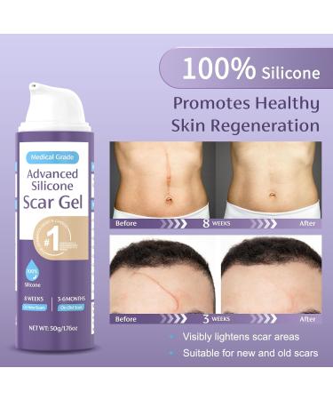 Skiennix 50g/1.76oz Advanced Scar Cream Gel - Medical Grade Silicone for Surgical Scars, Stretch Marks, Acne, Burns & Keloids - Effective Treatment for Old & New Scars - Buy Online on GoSupps.com