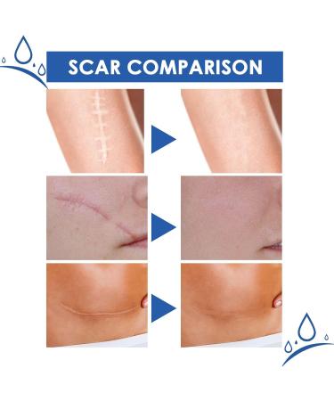 Scar Cream With Moisturizing Formula 30 G Cream for Fading and Repairing Scars Gel Removing Stretch Marks Soothing Effect For Knees Elbows Burns - Buy Online on GoSupps.com