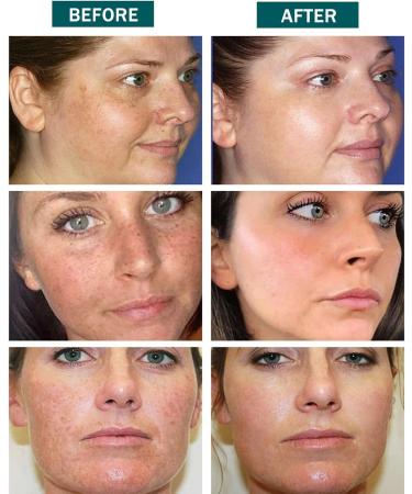 Dark Spot Remover for Face and Body - Sun Spots and Melasma Freckle Remover - Age Spot Remover for Face - Sunspots & Melasma Cream with Niacinamide - Hyperpigmentation Treatment Spot Treatment - Buy Online on GoSupps.com