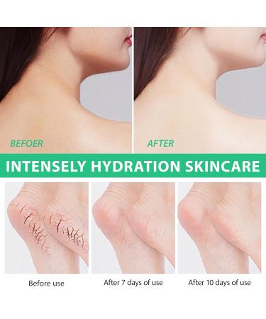 Urea Cream 40% for Feet - Maximum Strength with Salicylic Acid Hyaluronic Acid & Tea Tree Oil | Deep Moisturizer & Callus Remover 5.29 oz - Buy Online on GoSupps.com