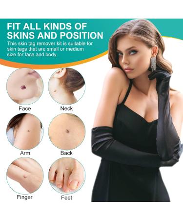 Skin Tag Remover 2 in 1 Kit for Medium/Large Skin Tags - Painless Mole Wart Treatment Tool for Face and Body - Buy Online on GoSupps.com