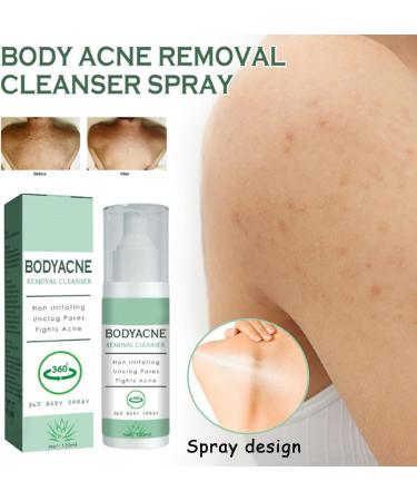 Acne Treatment Spary Back Acne Body Wash Aloe Soap for Face & Body Acne Marks Skin Care Spray Body Moisturiser For Acne Shoulder &Back Acne Reduce Back Acne& Nourishing-(Anti Acne Spray+Aloe Soap) - Buy Online on GoSupps.com